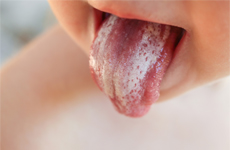 [Translate to Deutsch:] Tongue of a toddler with white plaque